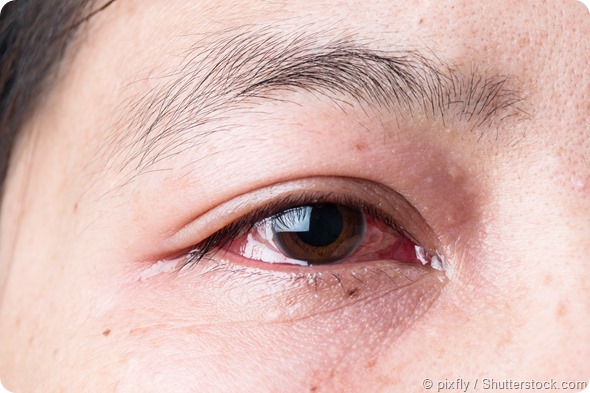 allergic conjunctivitis